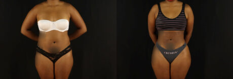 Brazilian Butt Lift case #5172
