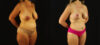 Mommy Makeover case #6517 slider thumbnail