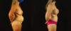 Mommy Makeover case #6517 slider thumbnail