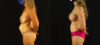 Mommy Makeover case #6517 slider thumbnail