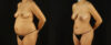 Mommy Makeover case #6518 slider thumbnail