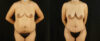 Mommy Makeover case #6518 slider thumbnail