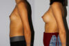 Breast Augmentation case #5640 slider thumbnail