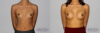 Breast Augmentation case #5640 slider thumbnail