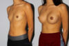Breast Augmentation case #5640 slider thumbnail