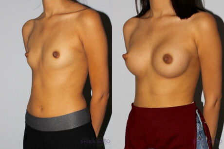 Breast Augmentation case #5640