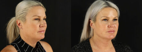 Submental Liposuction case #6948
