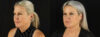 Submental Liposuction case #6948 slider thumbnail