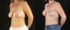 Breast Lift case #7762 slider thumbnail