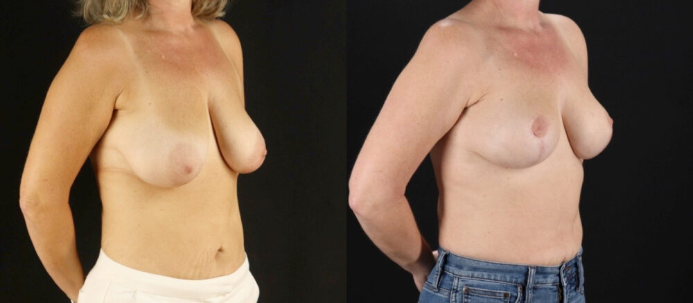 Breast Lift case #7762
