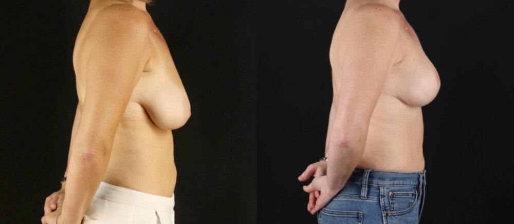 Breast Lift case #7762