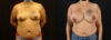 Breast Augmentation case #6384 slider thumbnail