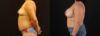 Breast Augmentation case #6384 slider thumbnail