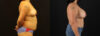 Breast Augmentation case #6384 slider thumbnail