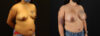 Breast Augmentation case #6384 slider thumbnail