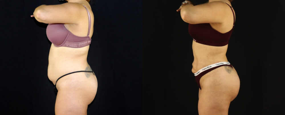 Brazilian Butt Lift case #5174