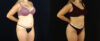 Brazilian Butt Lift case #5174 slider thumbnail