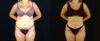 Brazilian Butt Lift case #5174 slider thumbnail