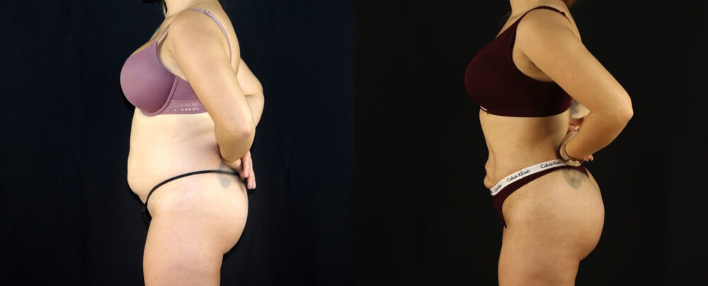 Brazilian Butt Lift case #5174
