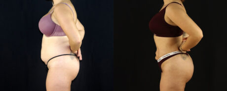 Brazilian Butt Lift case #5174
