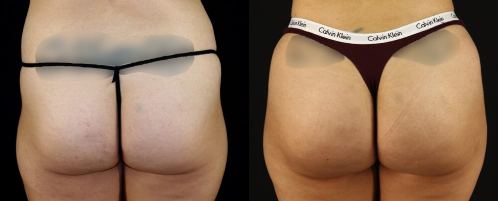 Brazilian Butt Lift case #5174