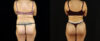 Brazilian Butt Lift case #5174 slider thumbnail