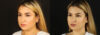 Submental Liposuction case #6949 slider thumbnail