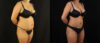 Brazilian Butt Lift case #5175 slider thumbnail