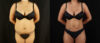 Brazilian Butt Lift case #5175 slider thumbnail