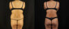 Brazilian Butt Lift case #5175 slider thumbnail