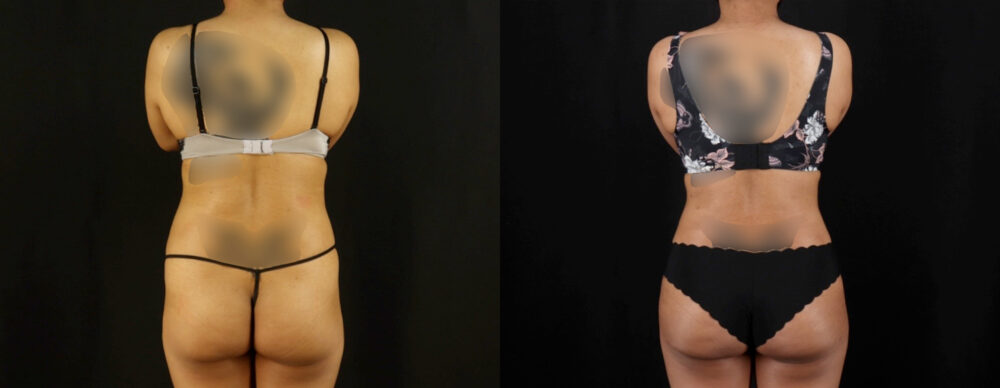 Brazilian Butt Lift case #5263