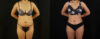 Brazilian Butt Lift case #5263 slider thumbnail