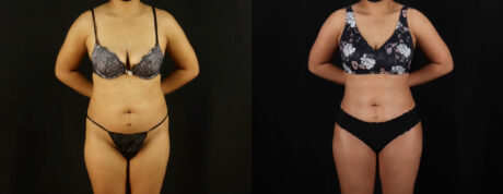 Brazilian Butt Lift case #5263
