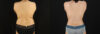 Mommy Makeover case #6525 slider thumbnail