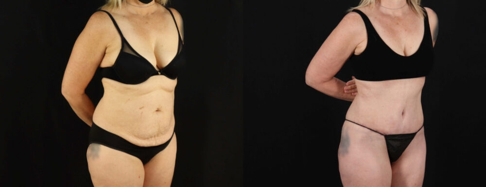 Tummy Tuck case #7351
