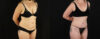 Tummy Tuck case #7351 slider thumbnail