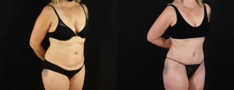 Tummy Tuck case #7351