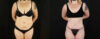 Tummy Tuck case #7351 slider thumbnail