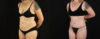 Tummy Tuck case #7351 slider thumbnail