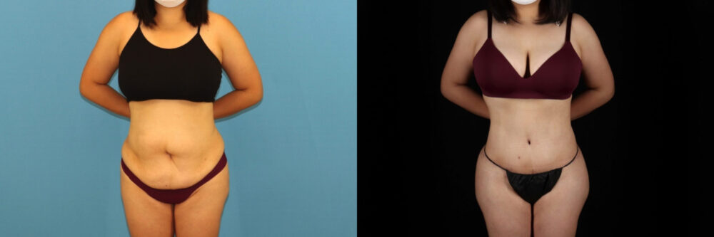 Tummy Tuck case #7352