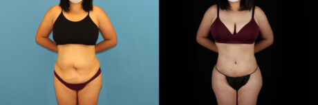 Tummy Tuck case #7352