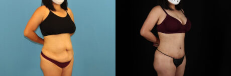 Tummy Tuck case #7352
