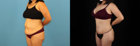 Tummy Tuck case #7352