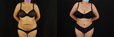 Tummy Tuck case #7469