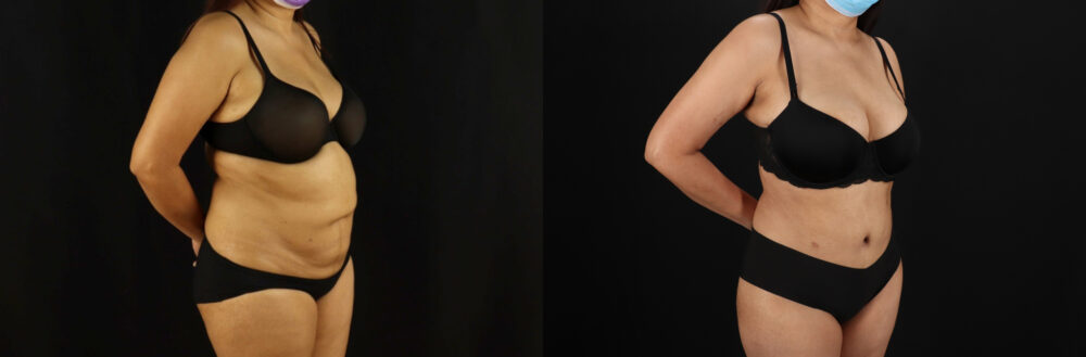 Tummy Tuck case #7469
