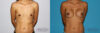 Breast Augmentation case #5618 slider thumbnail