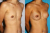 Breast Augmentation case #5618 slider thumbnail