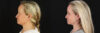 Renuvion RF Skin Tightening case #6928 slider thumbnail