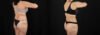 Tummy Tuck case #7462 slider thumbnail