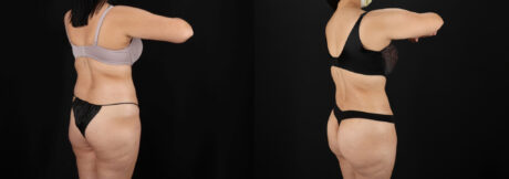 Tummy Tuck case #7462